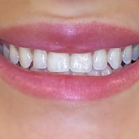 Composite bonding - Smile 11 before